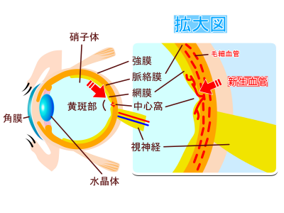 加齢黄斑変性についての画像1