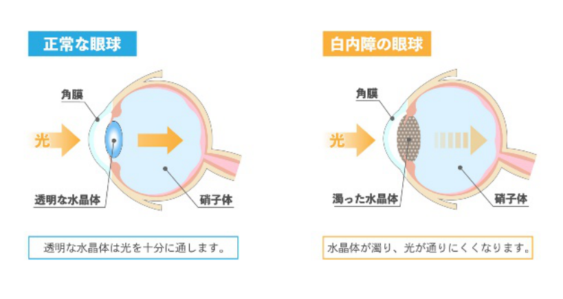 白内障についての画像1