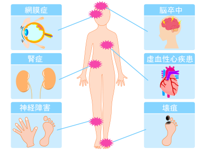 糖尿病網膜症についての画像1