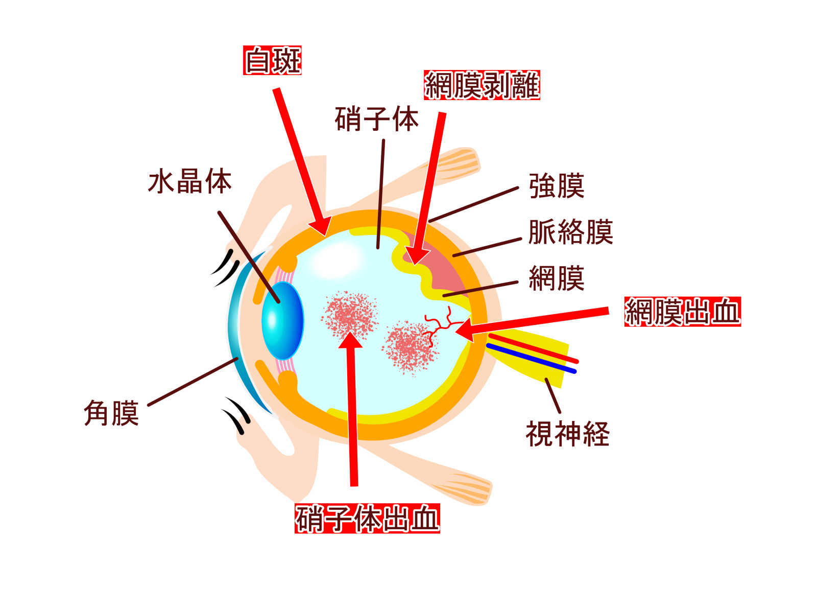 糖尿病網膜症についての画像2