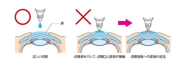 目薬を点眼する際の注意点についての画像