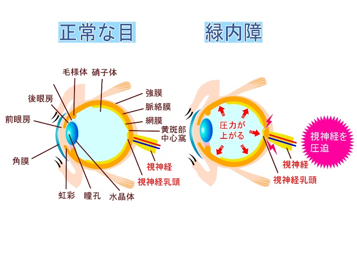 緑内障についての画像1