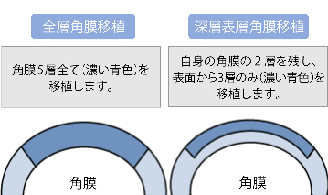 円錐角膜とはについての画像