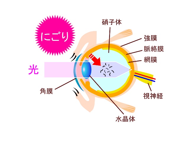 飛蚊症についての画像