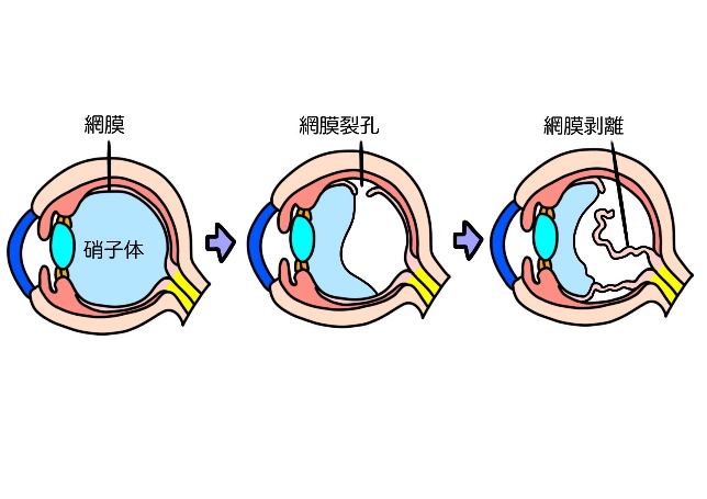 網膜裂孔についての画像