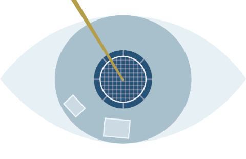 Laser cataract surgery process STEP4 Crushing the hard core of the crystalline lens