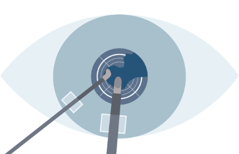 Laser cataract surgery process STEP5 Phacoemulsification