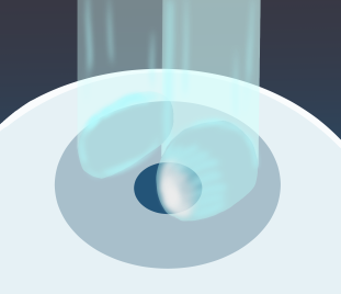 Corneal cross-linking surgery flow：STEP3 image