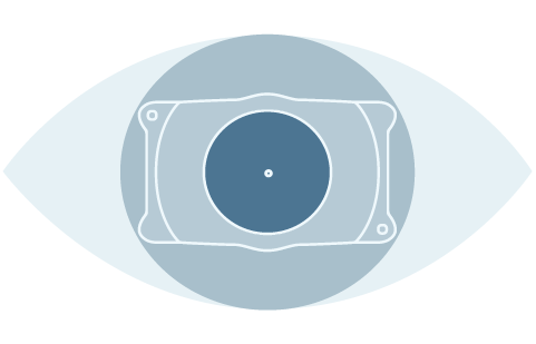 ICL surgery process STEP3 lens fixed