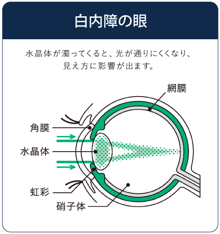 白内障の眼のイラスト