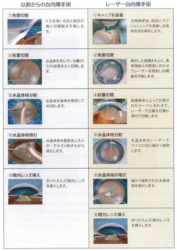 以前からの白内障手術とレーザー白内障手術の比較