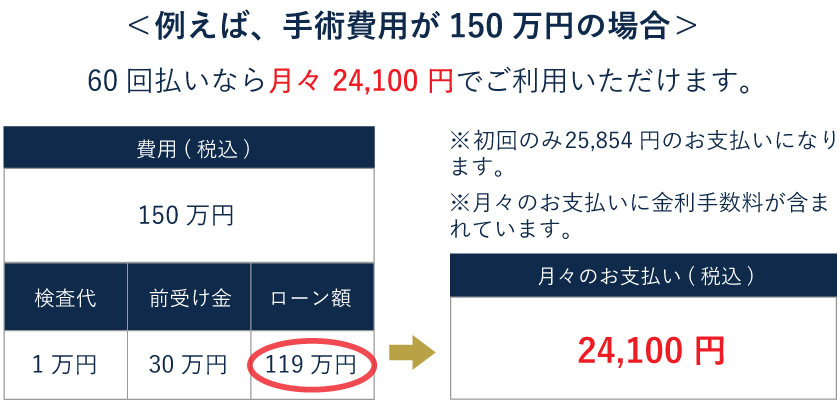 レーザー白内障手術（150万円の場合）の分割価格表