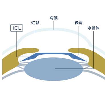 後房型フェイキックIOLの術式についての図解